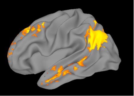 MRI scan of brain with active regions highlighted light orange