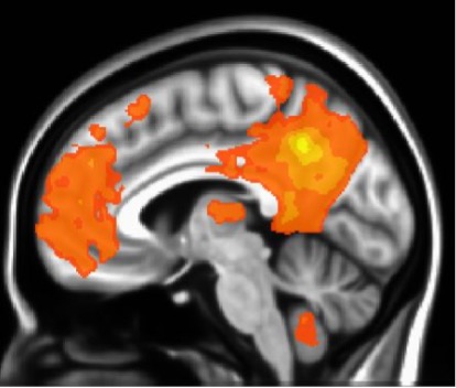 MRI scan of brain and skull with active areas highlighted in light to dark orange